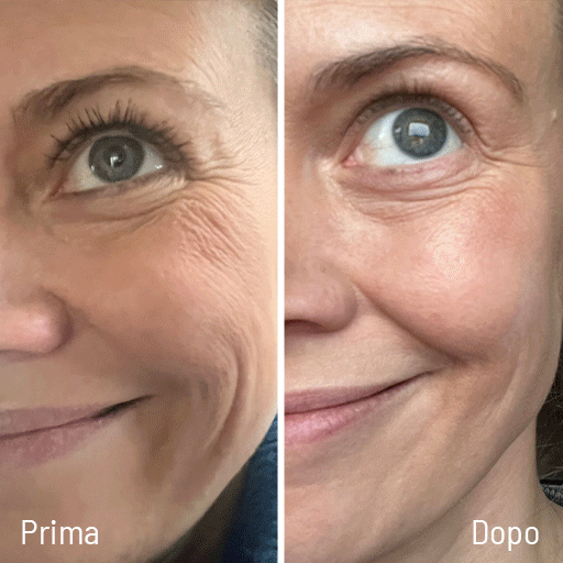 Prima e dopo riduzione rughe contorno occhi e diminuzione cellulite